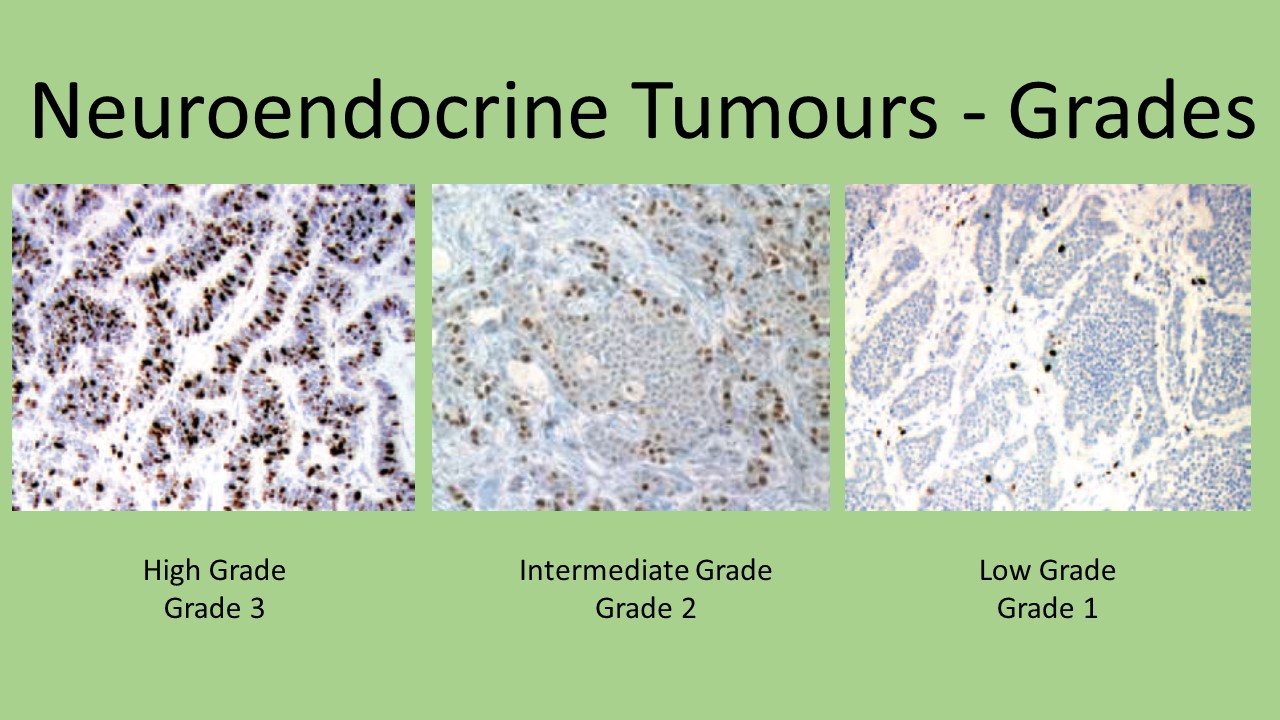 High grade neuroendocrine carcinoma