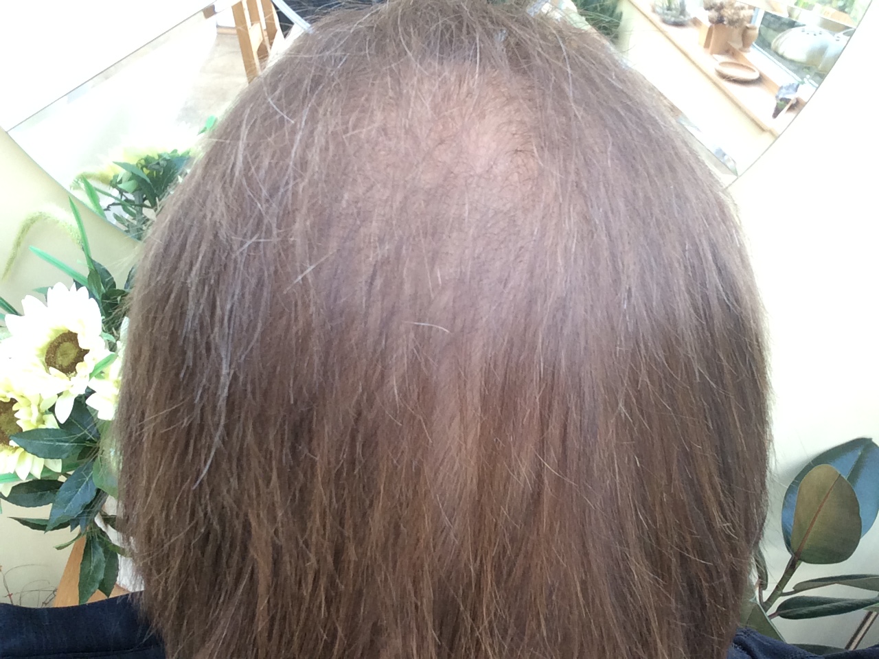Tips For Dealing With Thin Hair Breast Secondary Cancer Group