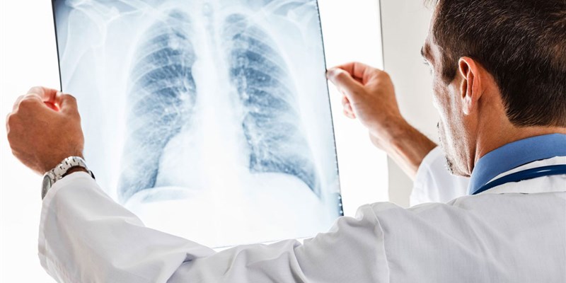 Lung Cancer Signs, Symptoms and Treatments