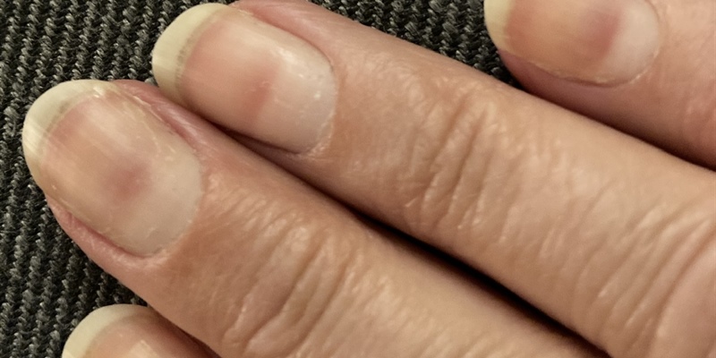 Chemo nail damage