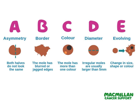 ABCDE with circles to show the differences in a mole. Asymmetry, border, colour, diameter, evolving.  