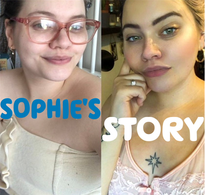 "Sophie's story" written over a picture of Sophie before surgery, and four months after her surgery. 