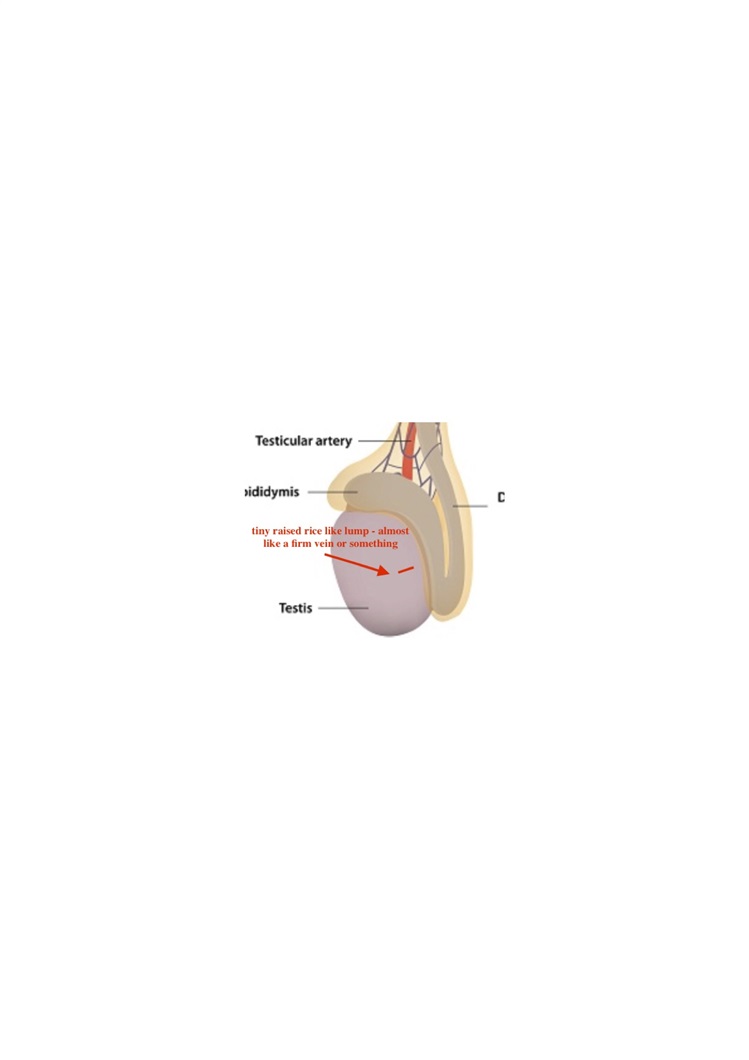 rice-like-lump-attached-to-the-testicle-could-it-be-a-cyst