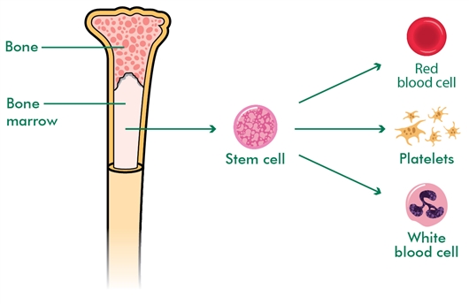 This illustration shows the structure of a bone in cross-section, with the bone marrow in the middle. An arrow from the bone marrow points to a blood stem cell. From the stem cell three arrows point to the three different blood cells – a red blood cell, a platelet and a white blood cell. This shows how red blood cells, platelets and white blood cells are all produced from blood stem cells which are found in the bone marrow.