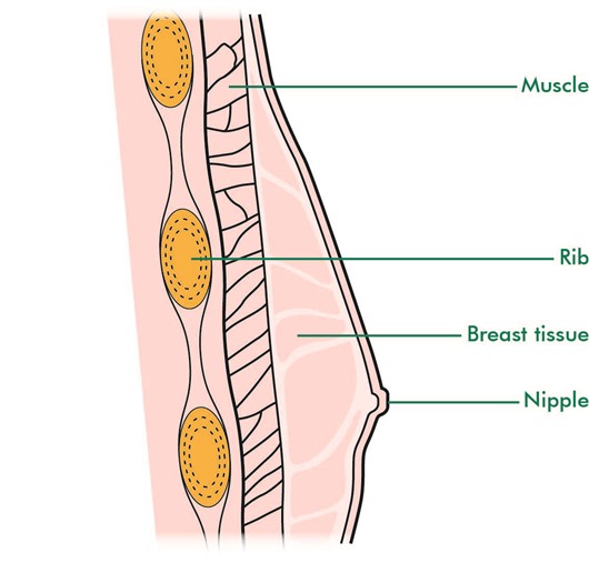  This illustration shows a cross section of the side view of a man’s chest. Behind the nipple is a small layer of breast tissue. Behind the breast tissue is a layer of muscle, then some of the ribs of the chest.