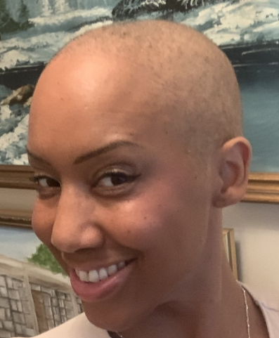 A photo of Wenda after hair loss, hair regrowth is just visible on her scalp