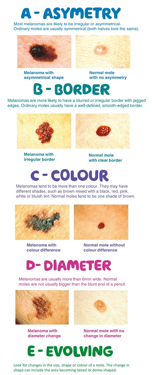 Skin Cancer Awareness Month – signs, symptoms and sun protection ...